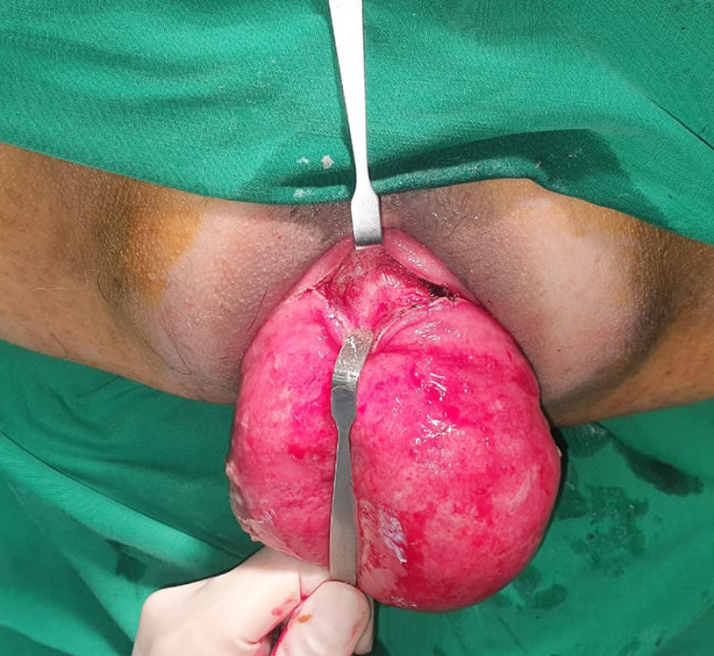A circumferential incision on the pre-marked line, including all layers of the rectal wall.