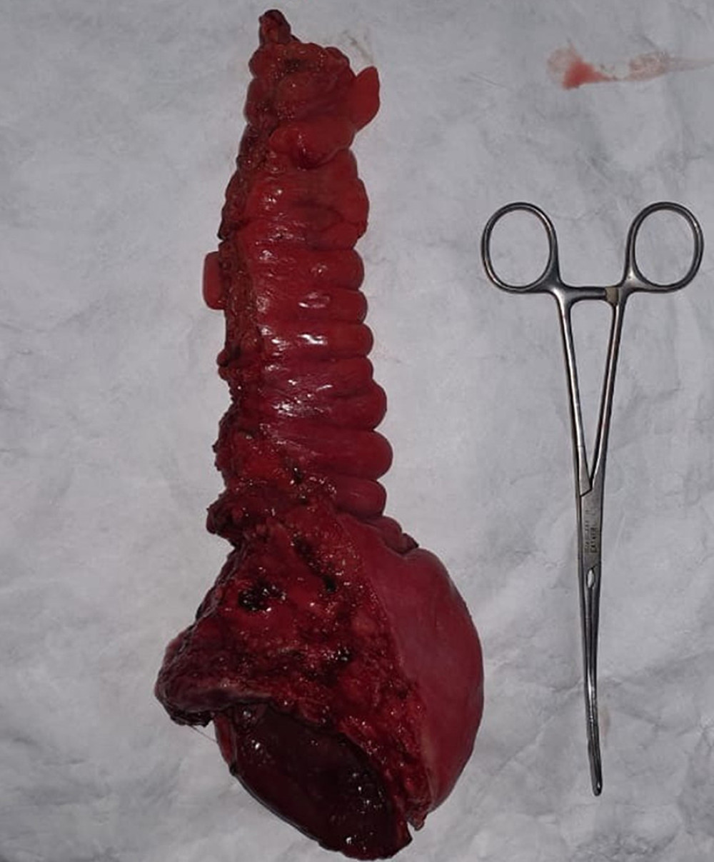 Resected prolapsed rectum and part of the sigmoid colon.