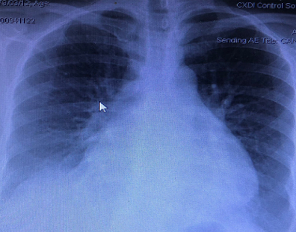 Chest radiograph (X-ray). Bilateral reticular infiltrates (white arrow is an artefact).
