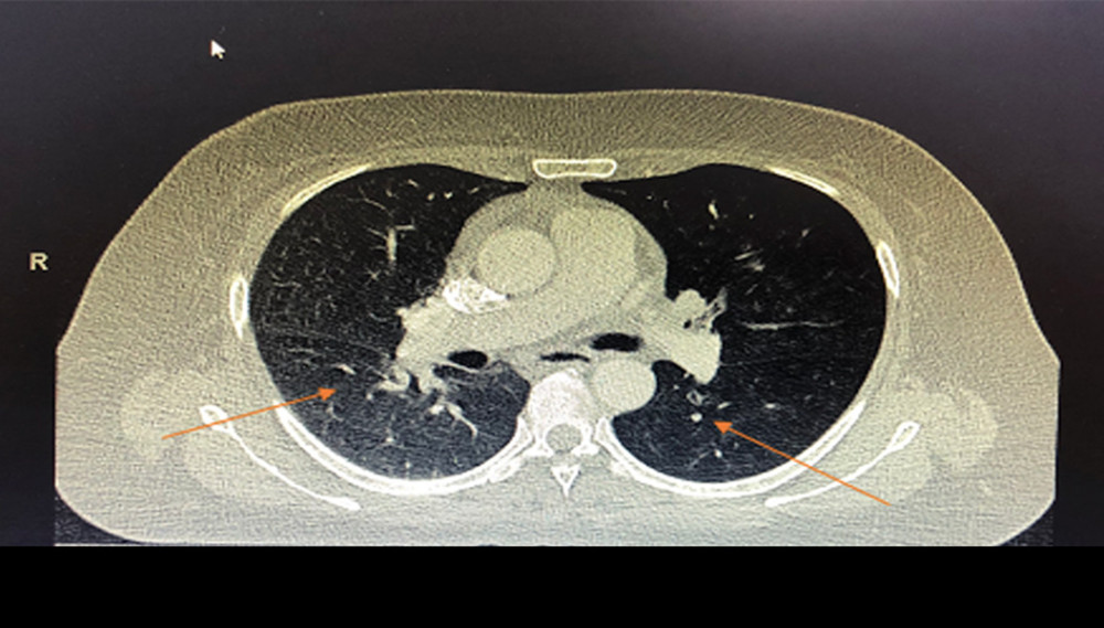 Computed tomography pulmonary angiogram (CTPA). No filling defects in pulmonary trunk. Apicobasal bilateral ground-glass opacification (orange arrows).