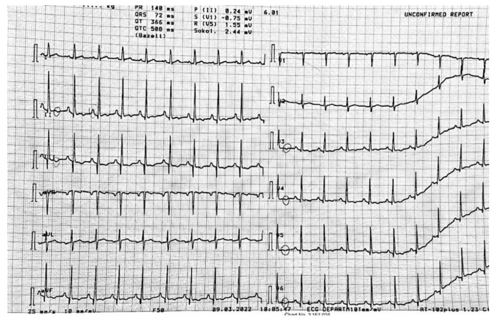 12-lead admission Electrocardiogram (ECG). Sinus tachycardia, P-pulmonale, Q3 T3 and inverted T waves in V3-V6.