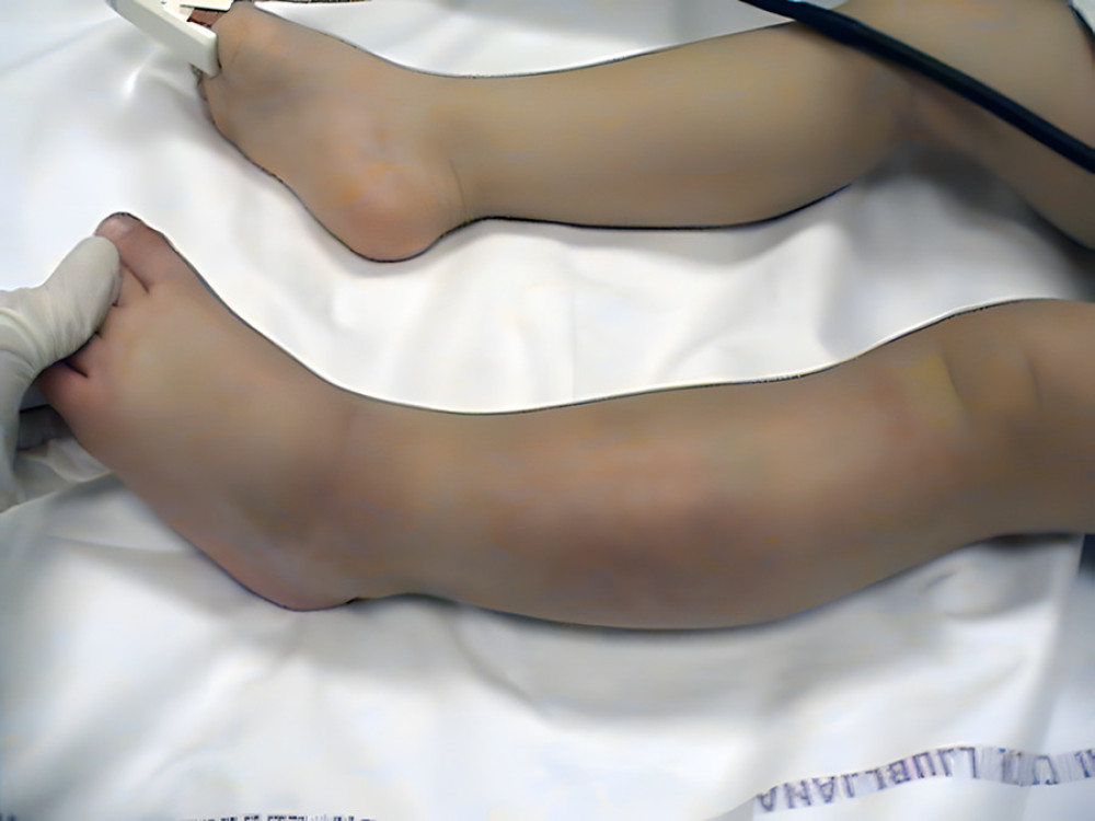 Photograph of both lower legs at the time of the admission showing swelling and bluish skin discoloration of the left shin.
