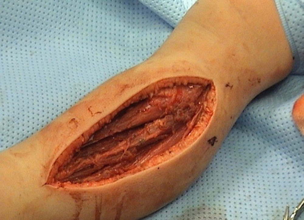 The wound after radical surgical debridement in the anterolateral compartment of the left shin.