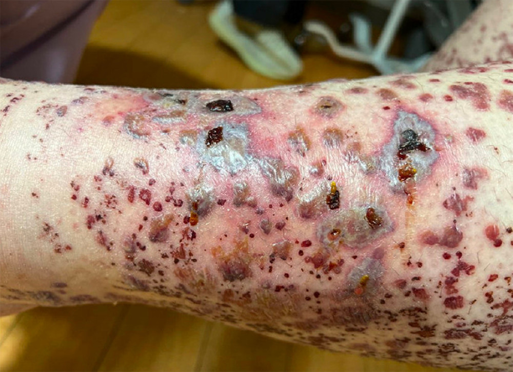 Rash on the trunk, upper, and lower extremities.