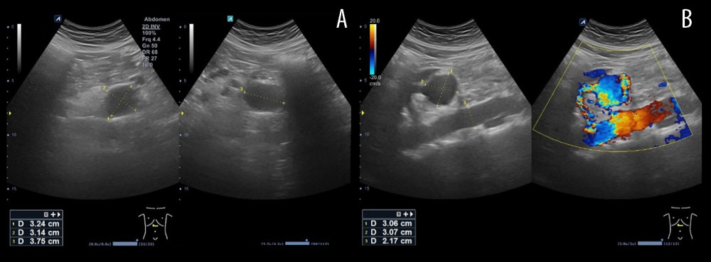 (A) Anechoic, rounded mass in the upper abdomen measuring 3.14×3.24×3.75 cm localized about 5 cm inferiorly to the corpus of the pancreas. (B) Color Doppler imaging confirming the presence of the blood flow in the lesion – visceral aneurysm of the SMA.