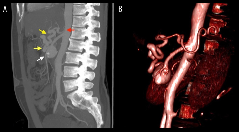 (A) CT demonstrating celiac trunk narrowing with typical hook sign (red arrow), aneurysm (white arrow) and large collateral vessel (yellow arrows) connecting celiac trunk and SMA, originating from the aneurysm and constituting for major blood supply to the liver. (B) Volume-rendering reformation.