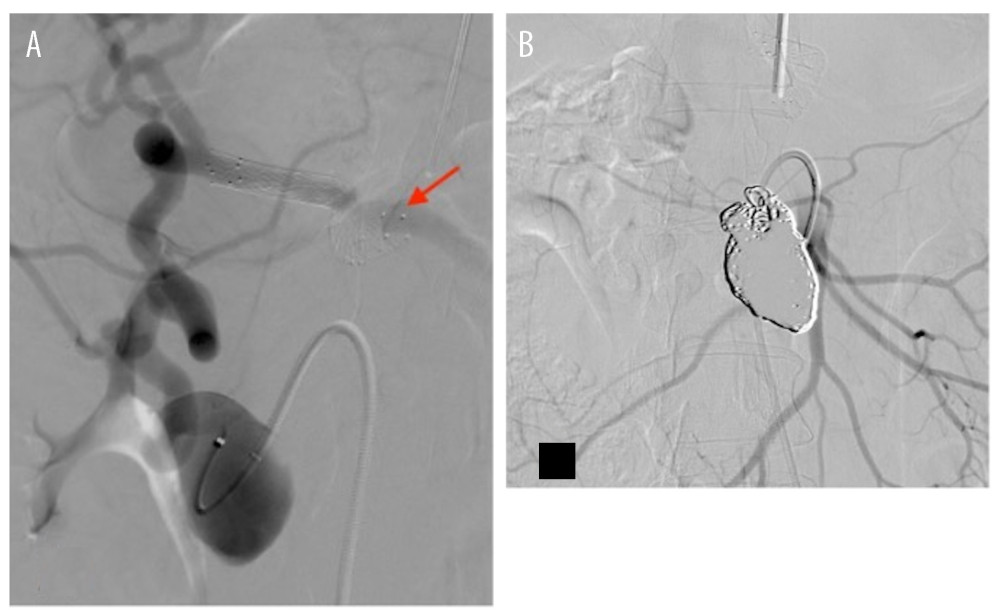 (A) Arteriography made from SMA showing aneurysm and implanted stent in the celiac trunk: good patency and restored blood flow through celiac trunk with collateral artery connecting the 2 vessels. (B) Fully embolized aneurysm with patent visceral arterial bed.