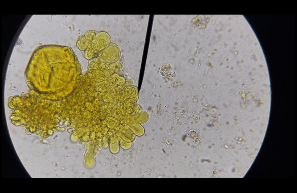 Microscopic identification of Urbanorum spp., determined in feces of an investigated woman, highlighting their shape, light yellow color, and morphology, using the direct coproparasitic method, as viewed under a light microscope using 40× objective and stained with Lugol’s solution.