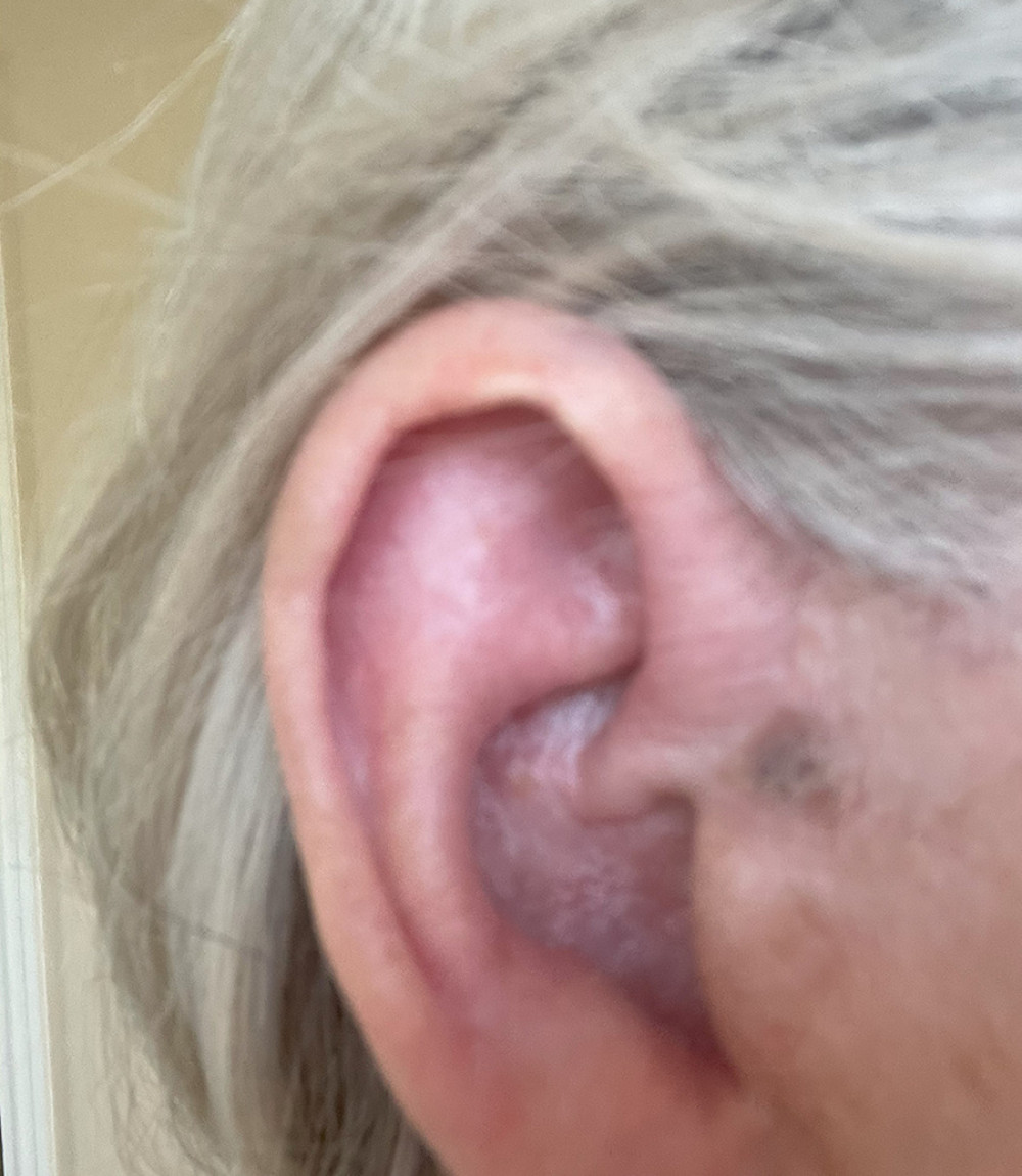 Visual examination of the patient’s right ear following outbreak.