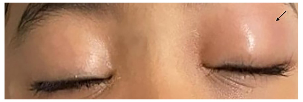 Left eye upper eyelid swelling and erythema.