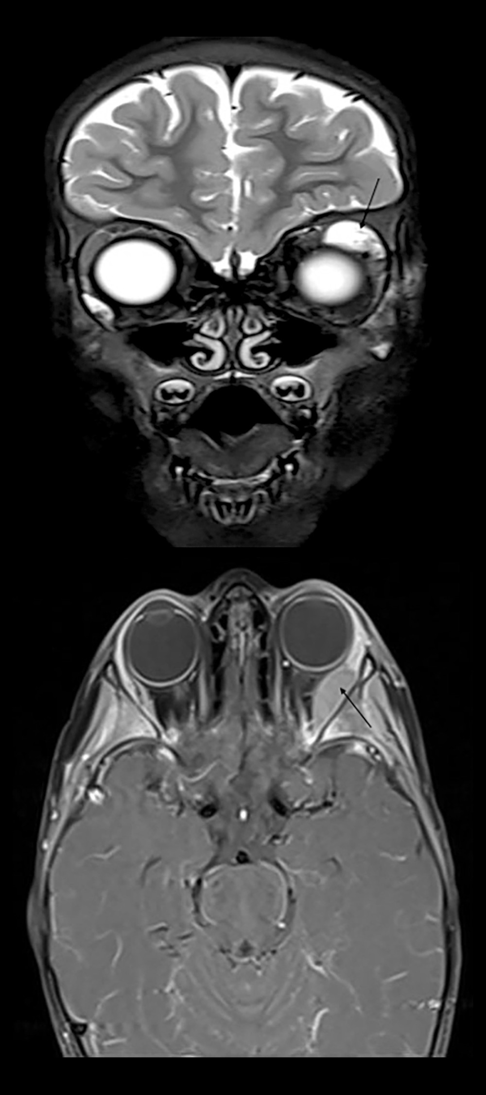 Magnetic resonance imaging with contrast. Bilateral subperiosteal heterogeneous collections were visible on an MRI with contrast: a large collection in the superolateral wall of the left orbit (2×0.8×2.1 cm) and a small collection in the inferolateral wall of the right orbit (1×0.6 cm). Both collections had intermediate-to-high T1 signal intensities and high T2 signal intensities. Additionally, the sphenoid and lateral orbital walls have both had bilateral osseous changes.