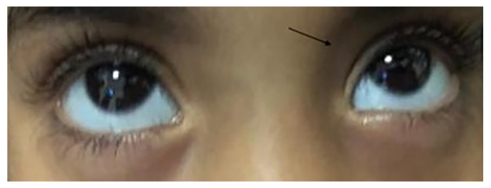 0Improvement in extraocular muscle movement with marked resolution of the periorbital swelling.