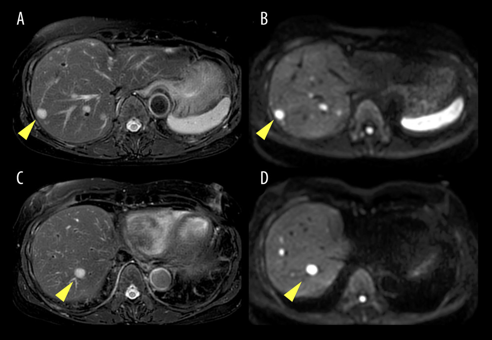 MRI demonstrating hyperintense hepatic masses on T2-weighted sequences (A, C) and restricted diffusion on diffusion-weighted sequences (B, D). MRI – magnetic resonance imaging.