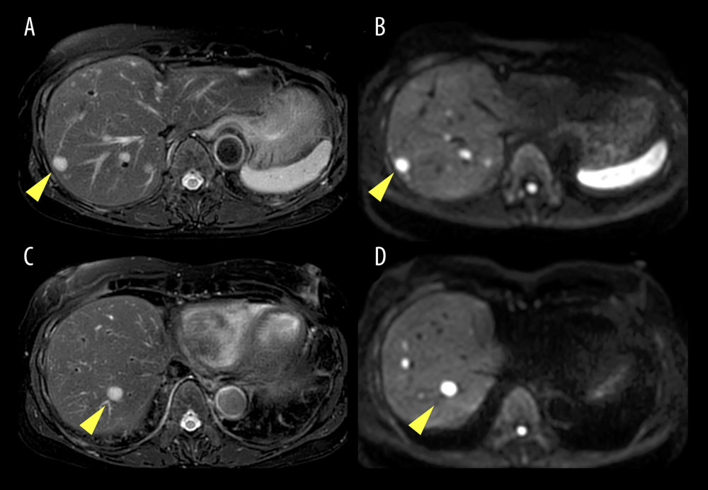 MRI demonstrating hyperintense hepatic masses on T2-weighted sequences (A, C) and restricted diffusion on diffusion-weighted sequences (B, D). MRI – magnetic resonance imaging.