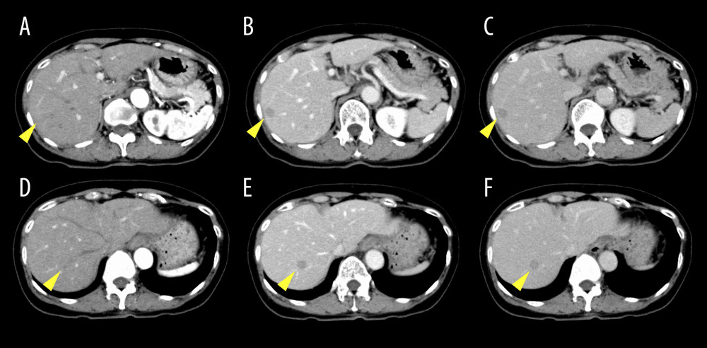 Contrast-enhanced CT revealed that the hepatic masses (arrowheads) appeared iso-dense in the first early phase (A, D) and low-dense in the second early and late phases (B, C, E, and F). CT – computed tomography.