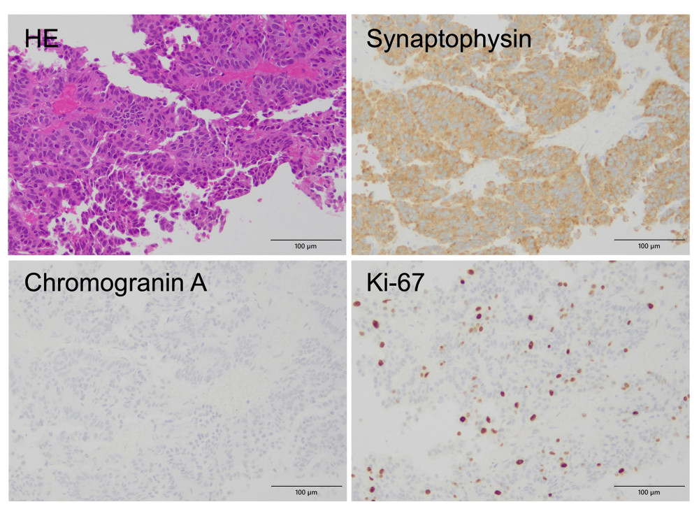 Pathological examination of the hepatic mass revealed the outgrowth of atypical tumor cells with trabecular and partly tubular structures. The tumor cells were positive for synaptophysin and negative for chromogranin A. The Ki-67-positive cell ratio was 12%. The upper left shows HE, the upper right shows synaptophysin, the lower left shows chromogranin A, and the lower right shows Ki-67. Scale bars, 100 μm. HE – hematoxylin-eosin staining.