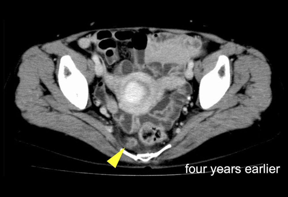 CT performed 4 years earlier showed a 12.7×13.4-mm cystic lesion in the presacral space. CT – computed tomography.