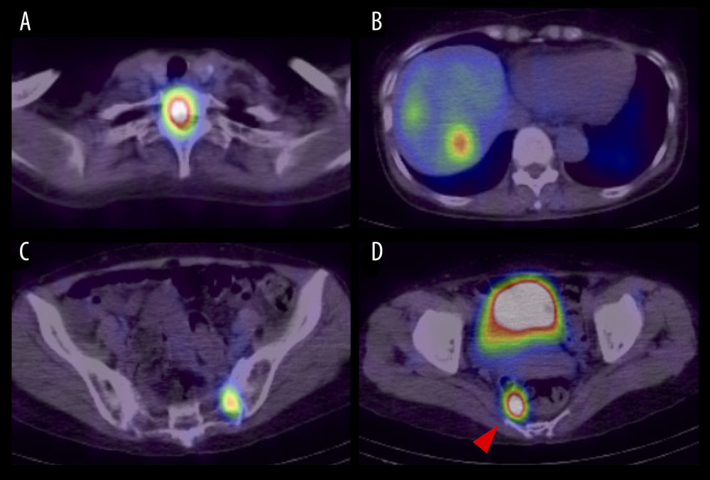 Somatostatin receptor scintigraphy with 111In-pentetreotide shows significant radiotracer accumulation, which represents the expression of somatostatin receptors on the first thoracic vertebra (A), hepatic masses (B), sacrum (C), and presacral mass (D, red arrowhead).