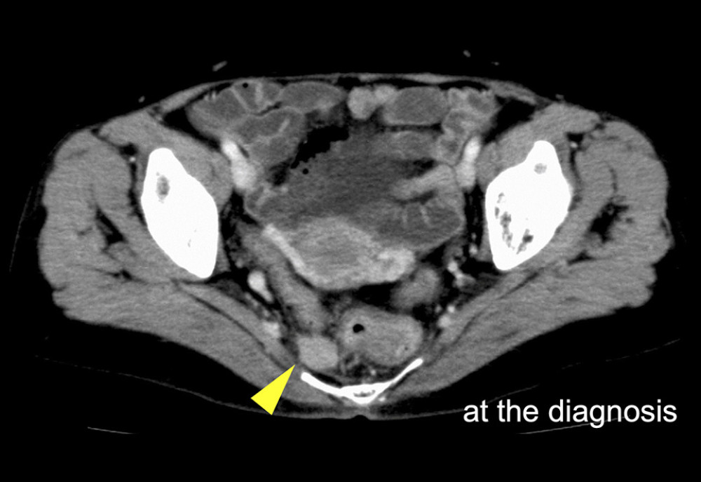 CT showing a 17.6×15.6-mm enhanced presacral mass at diagnosis. CT – computed tomography.