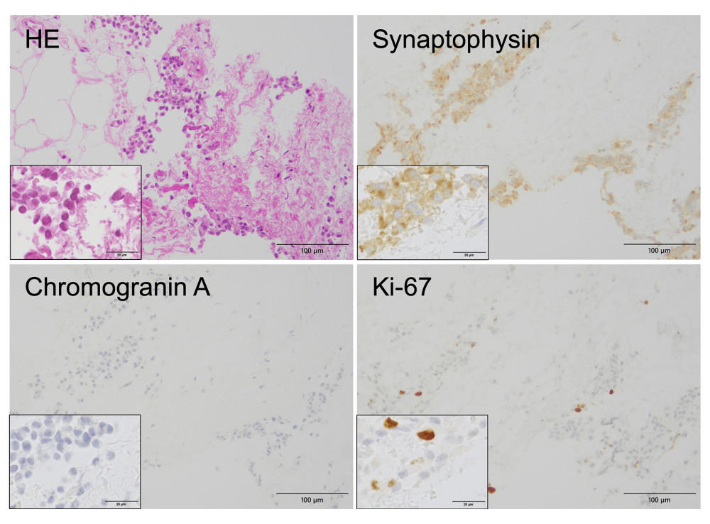 Pathological examination of the presacral tumor revealing tumor cells with a 4.5% Ki-67-positive cell ratio, which were positive for synaptophysin and negative for chromogranin A, similar to the NET in the liver. The upper left shows HE, the upper right shows synaptophysin, the lower left shows chromogranin A, and the lower right shows Ki-67. Scale bars, 100 μm (low-power field) and 20 μm (high-power field). NET – neuroendocrine tumor, HE – hematoxylin-eosin staining.