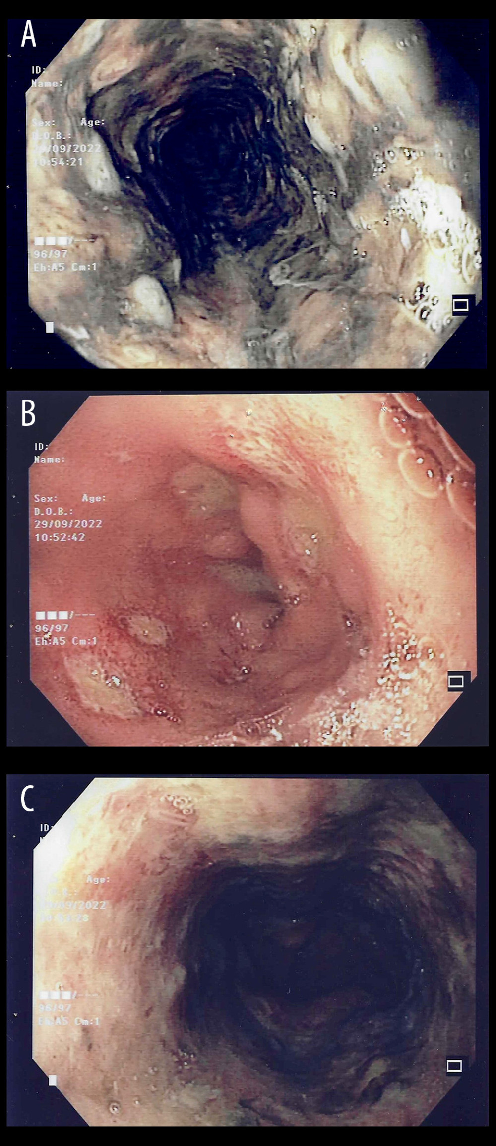 First esophagogastroduodenoscopy with circumferential necrotic mucosa: detail of the distal third of the esophagus (A); detail of the proximal gastric mucosa (B); detail of the middle third of esophageal mucosa.