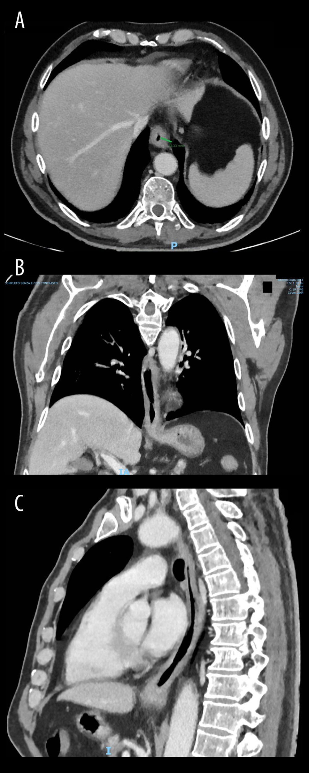 CT scan, transversal section of thorax, showing concentric thickening of the esophageal wall (A). The green line indicates the maximal thickening (13 mm); coronal section of thorax, showing craniocaudal extension of the esophageal wall (B); sagittal section of thorax, showing craniocaudal reduction of the esophageal lumen (C).