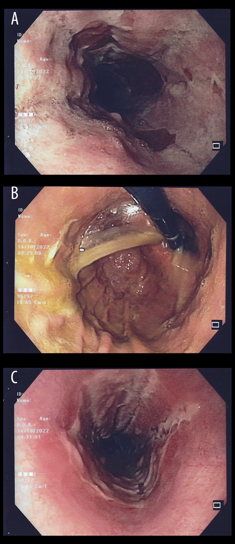 Second esophagogastroduodenoscopy with almost complete healing of necrotic esophageal mucosa: detail of the distal third of the esophagus (A); detail of the proximal gastric mucosa (B); detail of the middle third of esophageal mucosa (C).