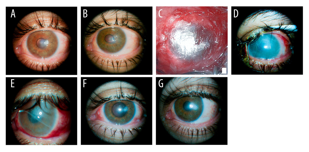 Stages of the corneal defect from initial presentation till 1 year after surgery. (A) Corneal ulcer a week prior to the patient’s presentation to our clinic and prior to indomethacin instillation. (B) Perforated corneal ulcer upon presentation. (C) Intraoperative photo at the end of surgery using a lyophilized amniotic membrane. (D) A week after intervention. (E) Two weeks after intervention. (F) Three months after intervention. (G) Twelve months after intervention.