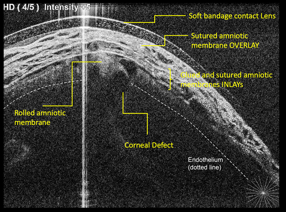 Anterior segment optical coherence tomography the day following surgery visualizing the different layers and confirming the position of the plug.
