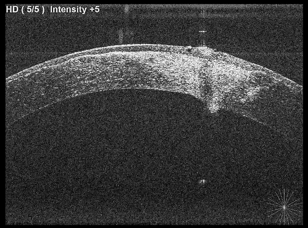 Anterior segment optical coherence tomography performed at 12 months showing a healed and scarred cornea.