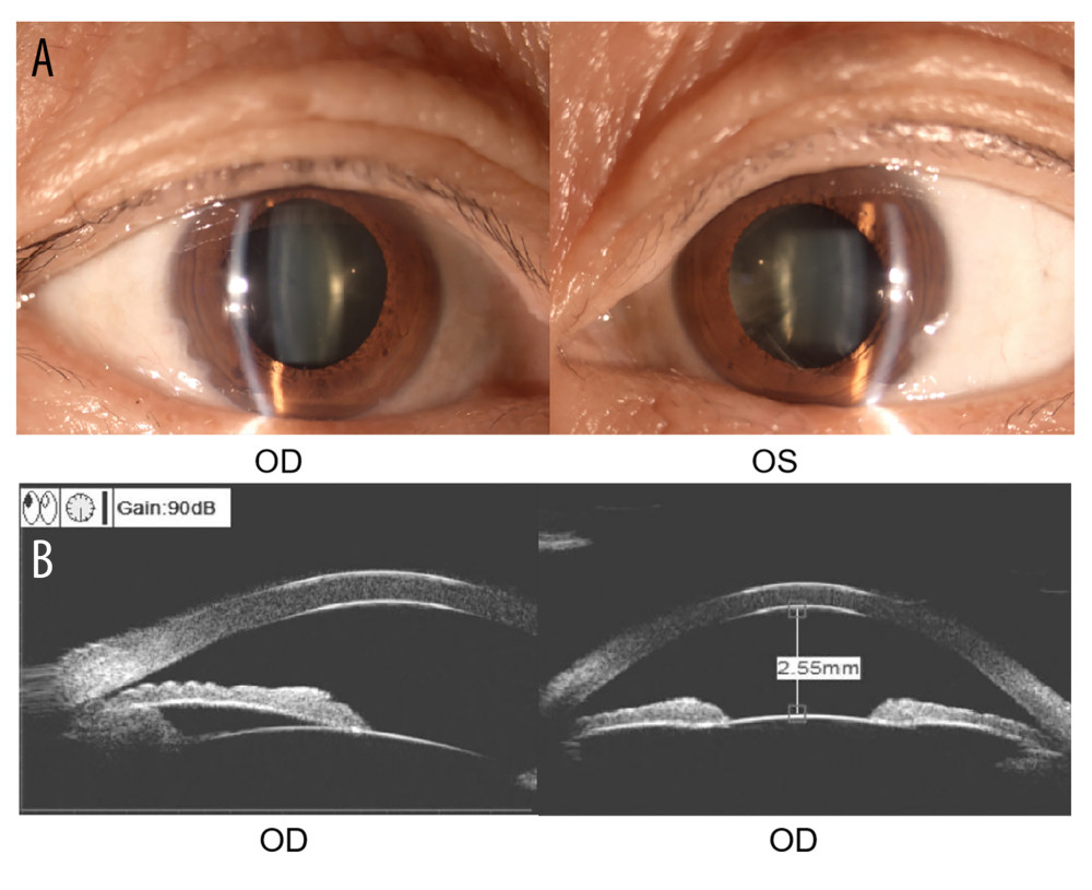 (A) Slit-lamp image of the anterior segment of the bilateral eyes. (B) Normal angle structure of right eye detected by ultrasound biomicroscopy.