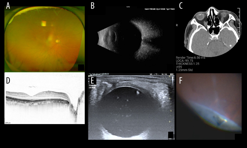 Montaged images of the right eye. (A) Normal fundus, shown by ultra-widefield imaging. (B) Normal vitreous and retina structure, shown by B-scan ultrasound. (C) Tiny IOFB detected in the vitreous behind the lens by CT scan. (D) Normal macular structure as indicated by OCT. (E) High reflection in the vitreous shown by color Doppler. (F) An IOFB in the pars plana shown by vitrectomy. IOFB – intraocular foreign body; OCT – optical coherence tomography.