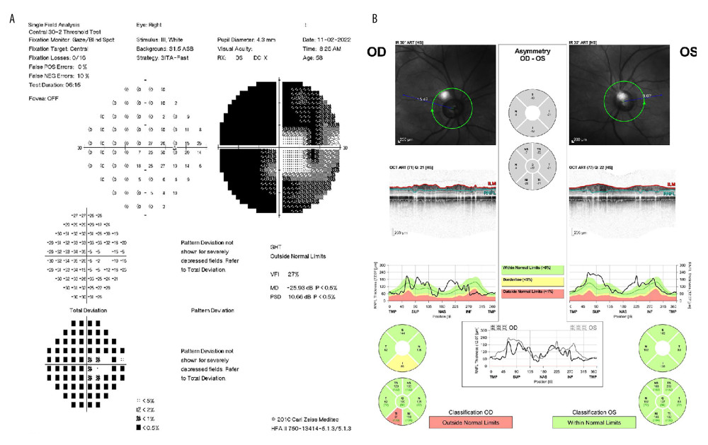 (A) Perimetry of the right eye by HVF-24-2 showing (B) retinal nerve fiber layer thickness in the right eye.