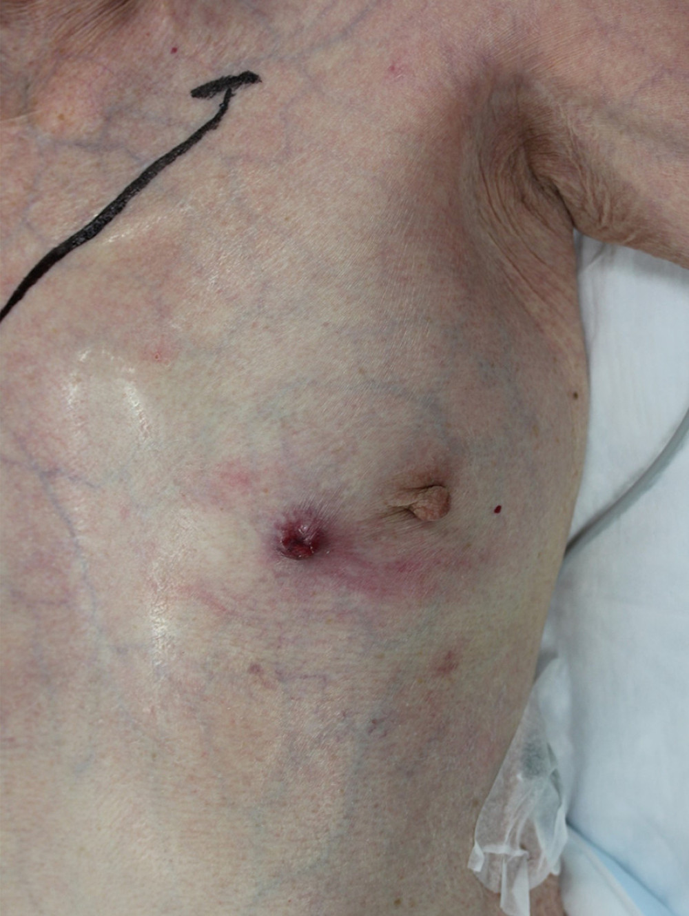 Palpation findings. A mass was palpable at 9 o’clock of the left breast. In addition, erythema was observed on the skin directly over the mass.