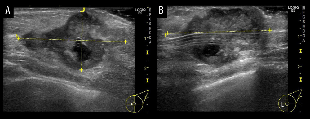Breast ultrasonography findings. (A) An irregular mass with indistinct borders and rough margins was observed at 9 o’clock of the left breast. The maximum diameter was 36 mm and the NTD was 19 mm. The irregular mass was associated with a rough marginal skin infiltrate and indistinct borders. (B) The VP shunt was observed in the center of the mass.
