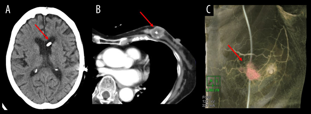 CT findings. The VP shunt traveled from the left ventricle through the center of the left mammary mass and into the abdominal cavity. (A) Head CT. The VP shunt was seen in the left lateral ventricle (arrow). (B) Contrast-enhanced CT of the chest. The VP shunt passed through the center of the left breast mass (arrow). (C) 3D-constructed image of contrast-enhanced CT. A VP shunt was placed in the thoracoabdomen via the center of the mass (arrow).