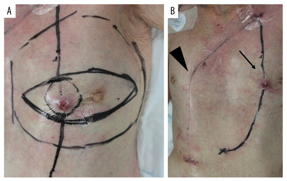 Surgical findings. (A) Preoperative marking. (B) Prior to surgery, the VP shunt passed through the left thoracoabdominal region (arrow). The VP shunt was rerouted to the right thoracoabdomen and placed in the abdominal cavity (arrowhead). The fistula in the abdominal wall was removed to prevent recurrence in the shunt’s pathway.