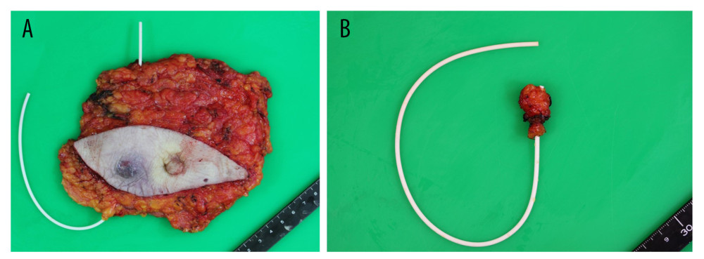 Surgical specimen. The left breast and abdominal wall fistula were removed along with the shunt tube. (A) Surgical specimen of the breast. (B) Surgical specimen of the abdominal wall fistula.