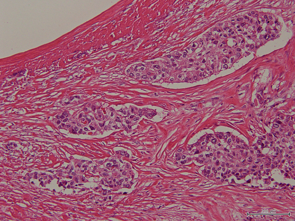Pathological finding of excised mammary gland. Hematoxylin and eosin staining section (200×) showed tumor cell infiltration with collagen fibril growth around the VP shunt (upper left); the VP shunt was located in the upper left of this figure and was hollow.