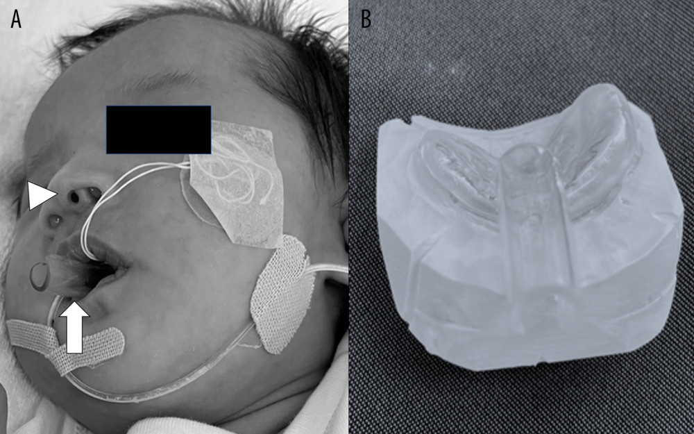 Supernumerary nostril and mouth piece. (A) Arrowhead indicates the third nostril. Arrow indicates the mouthpiece. (B) Mouthpiece.