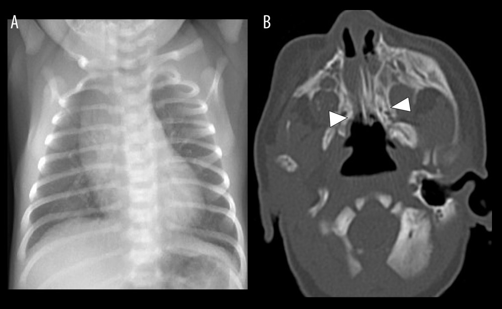 Chest X-ray and head computed tomography. (A) Chest X-ray. (B) Arrowhead indicates bilateral membranous choanal atresia.