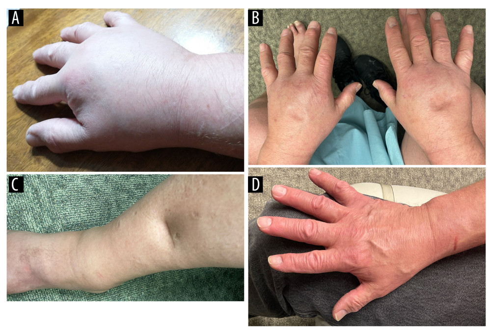 (A) Swelling of the hand when first noted by the patient. Pitting edema of the bilateral (B) hands and (C) leg when evaluated in clinic. (D) Resolution of swelling after treatment with prednisone