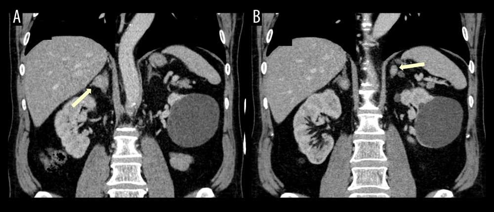 Intravenous contrast-enhanced abdominal CT (portal phase), coronal reconstructions, showing the 2 indeterminate adrenal nodules (yellow arrows, A – right adrenal gland; B – left adrenal gland).