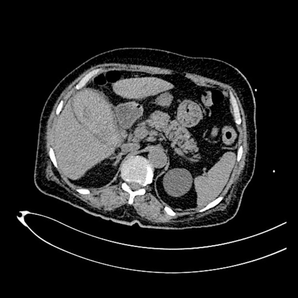 Axial non-contrast CT scan of the abdomen shows distended gallbladder by intraluminal hyperdense material with average of 48 Hounsfield units. Increased wall thickness. No stones or masses seen.