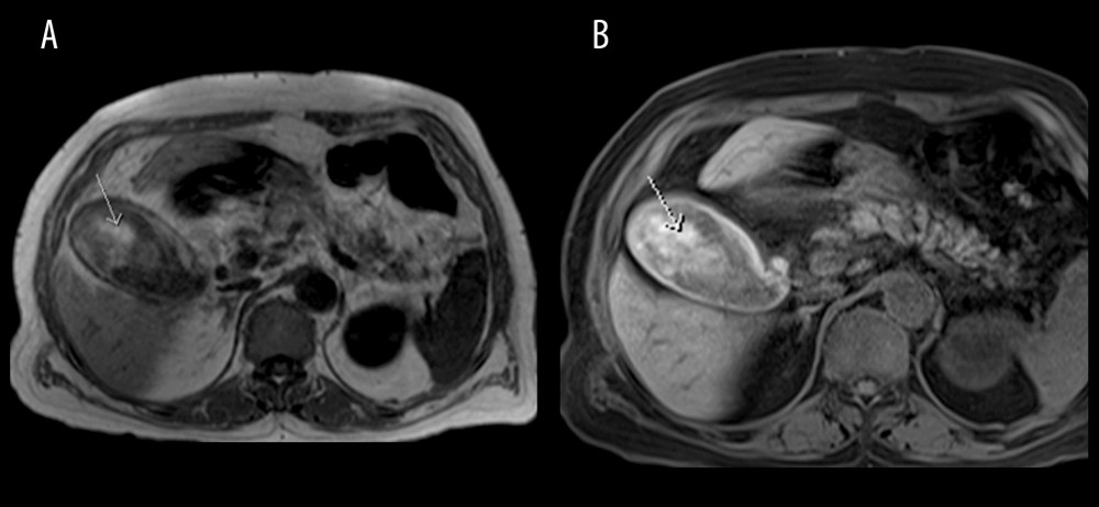 Axial T1- (A) and T1 FS- (B) weighted images from non-contrast MRI abdomen shows distended gall bladder by intraluminal hyperintense material (arrowed) and thickened hyperintense wall.