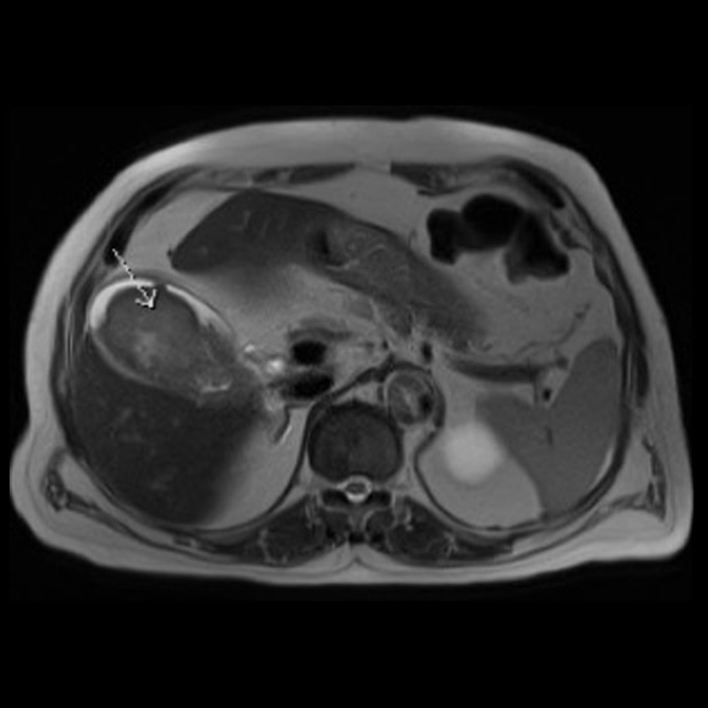 Axial T2-weighted image from non-contrast MRI abdomen shows distended gall bladder by intraluminal mildly hyperintense material (arrowed) and thickened bright wall.