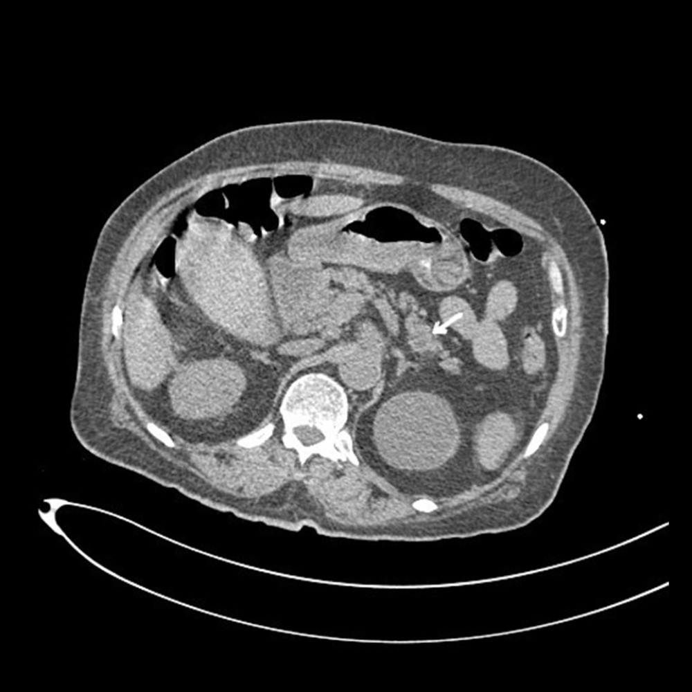 CT scan of the abdomen showing pancreatic cyst (arrow).