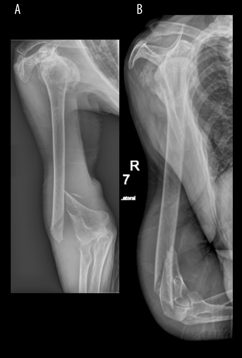 Anterior-posterior (A) and lateral (B) radiographs taken on initial presentation to hospital.