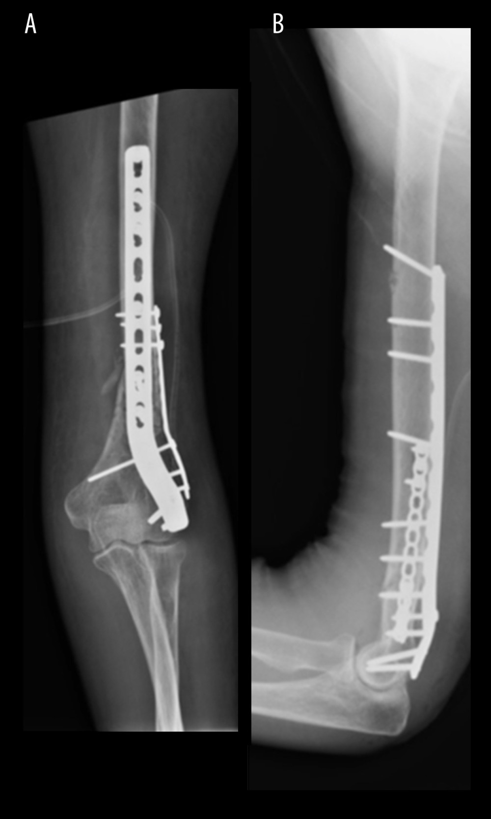 Postoperative radiographs showing anterior-posterior (A) and lateral (B) views of initial ORIF.