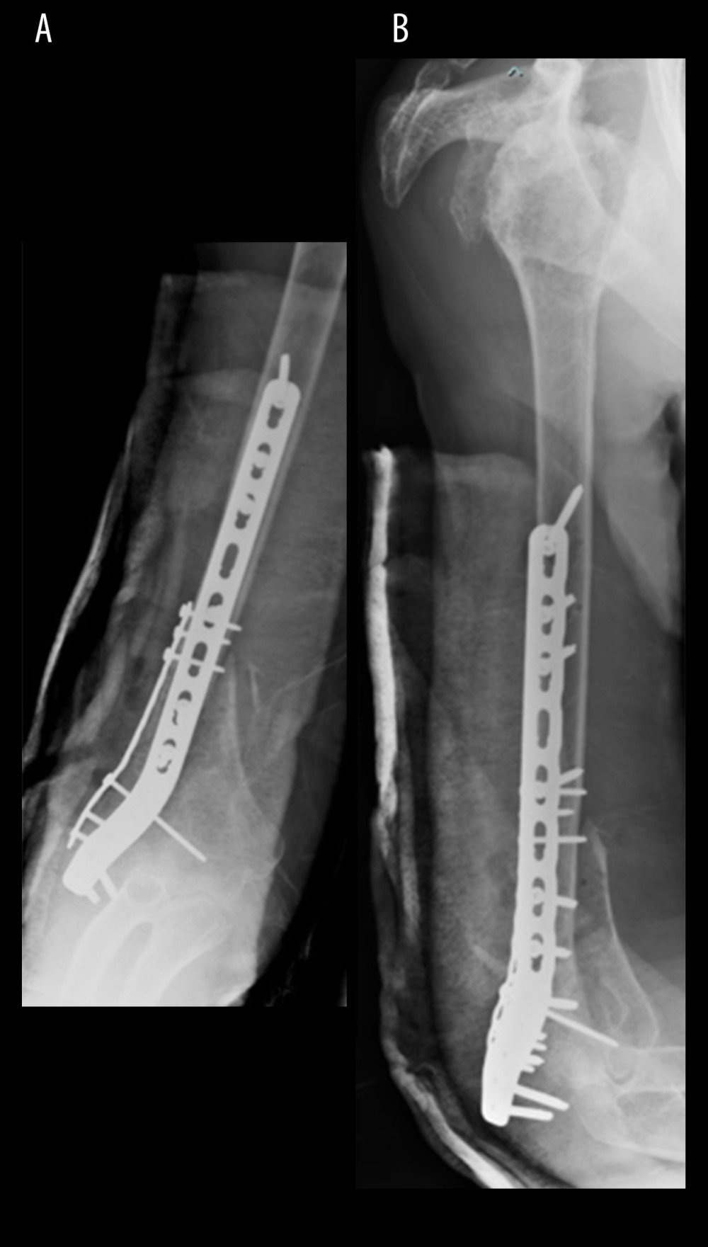 Anterior-posterior (A) and lateral (B) radiographs taken on return to hospital with failure of fixation.